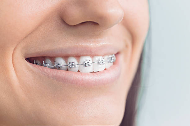 Best Teeth Whitening  in University City, MO